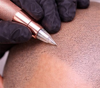 dermopigmentation saintes